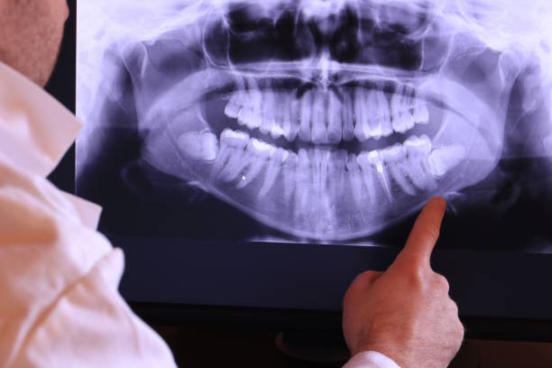 Best Emergency Tooth Extraction in Nampa, ID