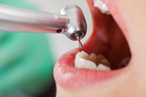Best Emergency Wisdom Teeth Removal in Nampa, ID